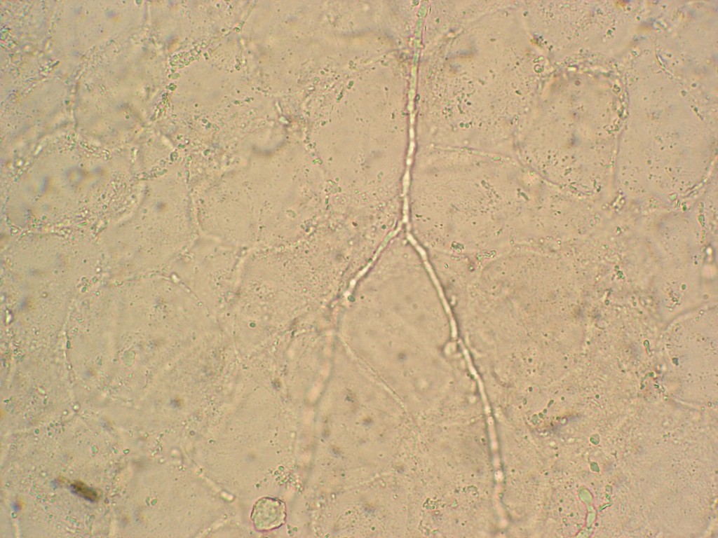加滴10% koh制片,显微镜下可见有分隔和分支的透明菌丝或关节孢子即为