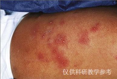 临床图片      细菌性毛囊炎:以毛囊炎为基础,红斑性丘疹脓疱最初存在
