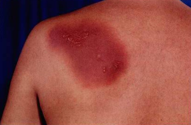皮疹特点是限局性圆形或椭圆形红斑,红斑鲜红色或紫红色,水肿性,炎症