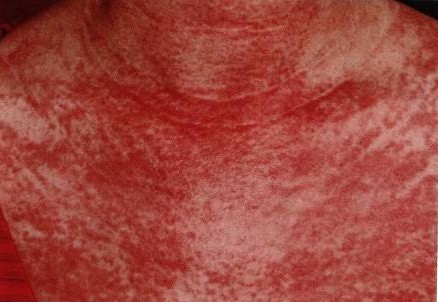 主要皮损处 gottron丘疹外,有面部,颈部,上胸部和背部的紫红色斑疹(图
