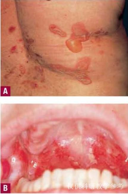 天疱疮 临床图片     寻常型天疱疮:广泛分布的融合性糜烂是非常疼痛
