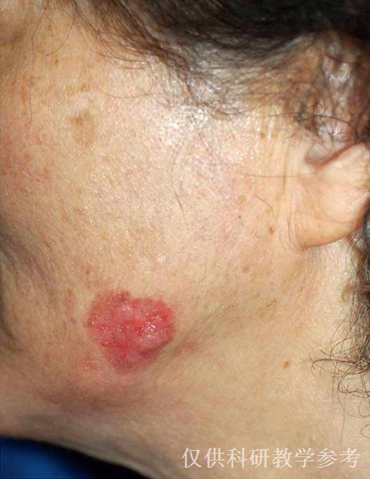 ">鲍恩病:左侧下颌角处的基于不规则形状红斑性斑块上的红斑型丘疹 br