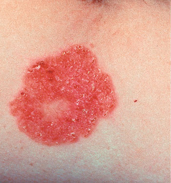 看图识病  鲍恩病(bowen"s disease)1912年由bowen首次报道,也称上