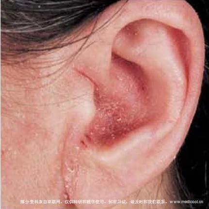 Micoza urechii (Otomicoza)