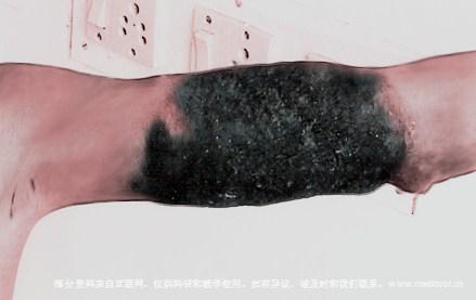 着色芽生菌病-四肢