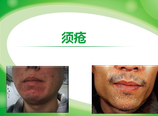 须疮