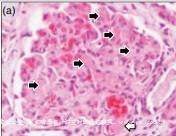 肾小球微血栓显示(黑箭头),在肾小球毛细血管.相邻的肾小球176_136