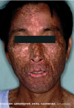 着色性干皮病 临床图片       图片来源: 中国临床皮肤病学