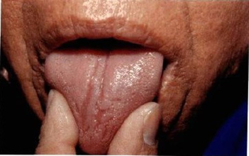 口角见褐色小乳头状隆起,舌面乳头状增生,有深沟纹