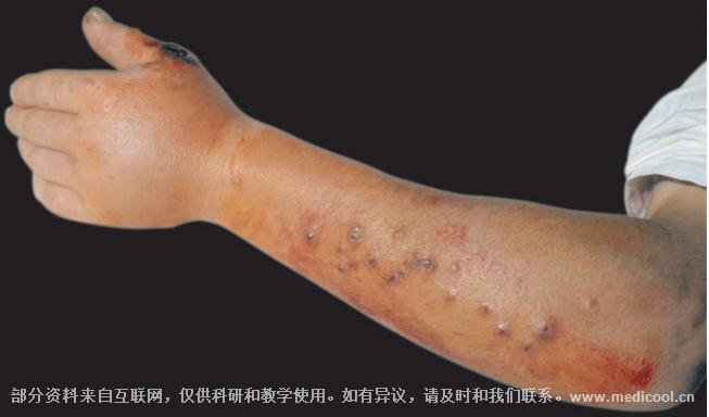 5;">炭疽:一个来自于拇指向近端延伸的结节性淋巴管炎性病变.