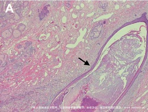 14px>组织病理学检查发现由真皮,皮下组织和表皮囊肿(箭头)内增生的