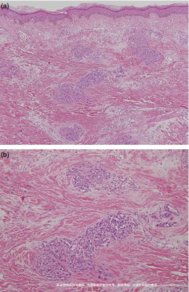 5;">从状血管瘤:多个散在的真皮细胞 /span> span style="font-family