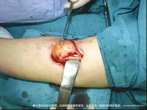 style="font-size:14px;">增大后的正中神经通过神经内成纤维脂肪瘤