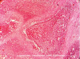 性病性淋巴肉芽肿-组织病理图