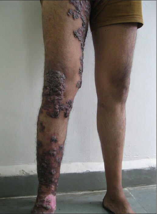 整个右下肢的表皮疣状结核广泛多灶性病变