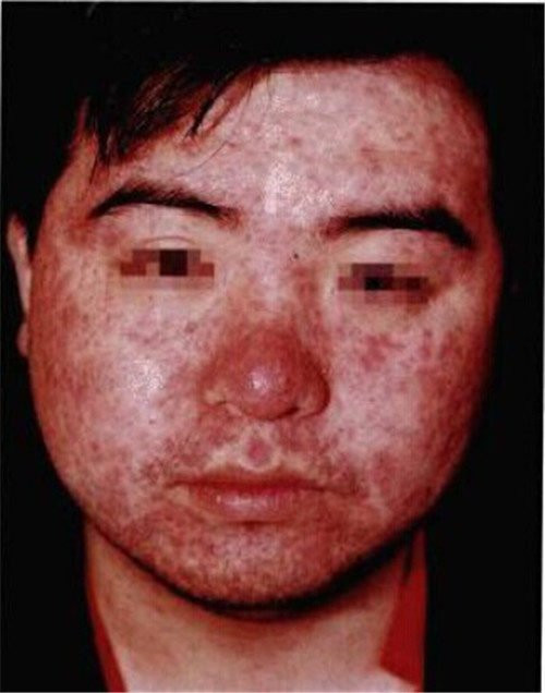 发生在面部皮疹呈玫瑰色斑丘疹,疹密集,但疹间皮肤正常
