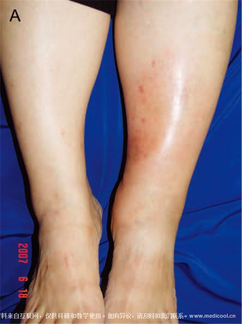 a,患者,48岁,女性,左小腿内侧红斑性边界不清斑块1月.