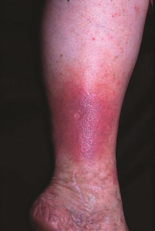 剧烈的青斑样红斑和有光泽的皮肤水肿,让人联想到蜂窝组织炎