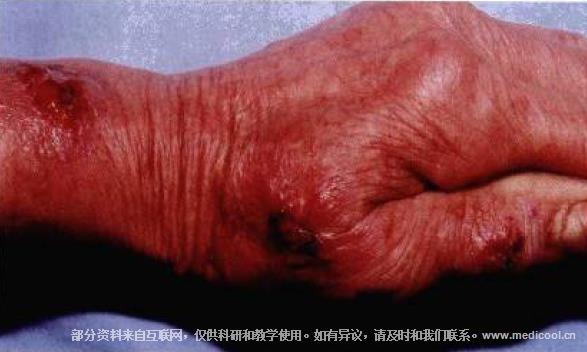 手背至腕部呈线状排列,红色疣状浸润性肉芽肿性斑块及溃疡,表面结痂